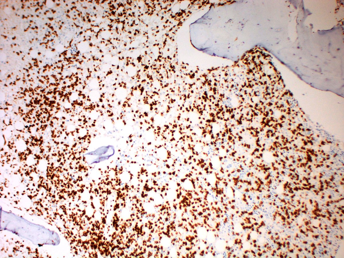 Atypical lymphoid cells staining for CD3 (Immunoperoxidase, 200x)